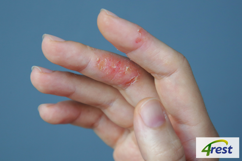 1. Thế nào là da nhạy cảm và viêm da cơ địa?